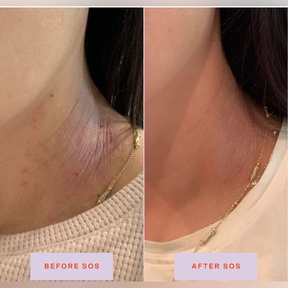 New SOS Tower 28 Daily Rescue Facial Spray - Spray Protecteur for Skin Flare-Ups - Picture 5 of 13